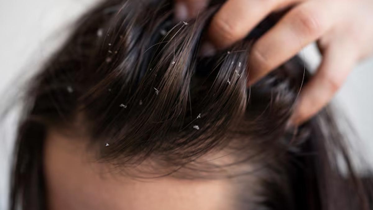 Home-Remedies-for-dandruff-inside