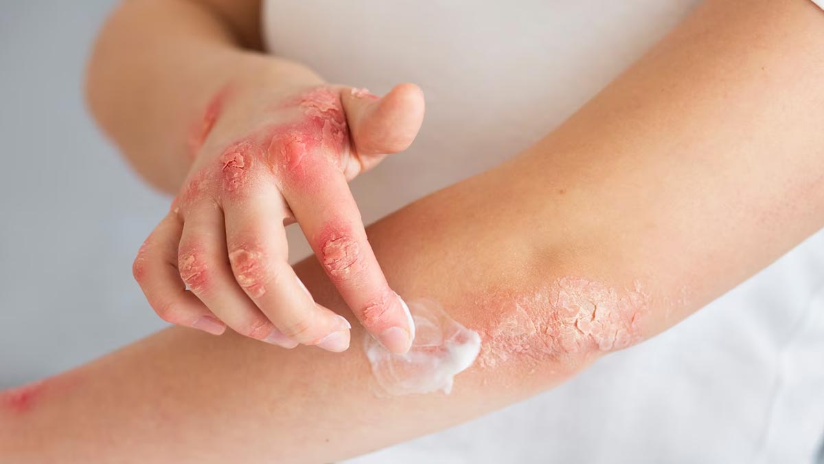 How-Ultra-Processed-Foods-Are-Affects-Psoriasis How-Ultra-Processed-Foods-Are-Affects-Psoriasis-in