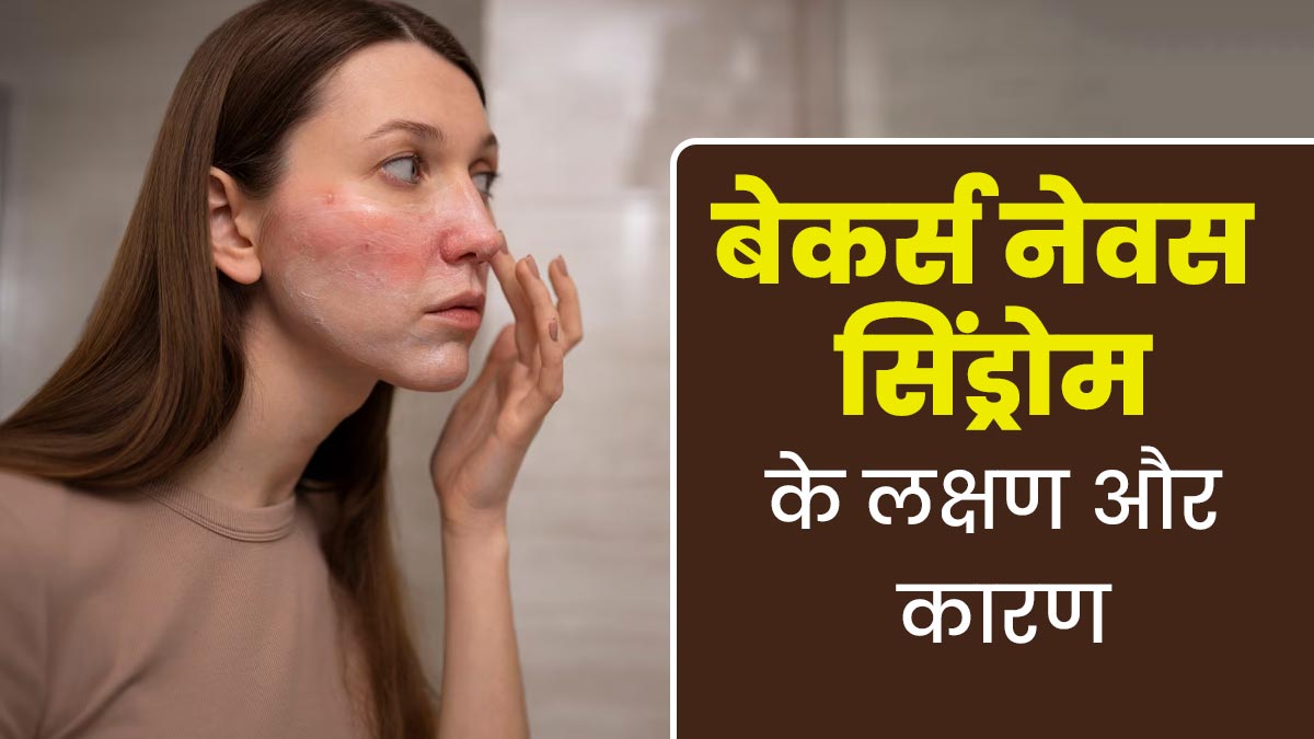 त्वचा और मांसपेशियों को प्रभावित कर सकता है बेकर्स नेवस सिंड्रोम, जानें इसके लक्षण और कारण