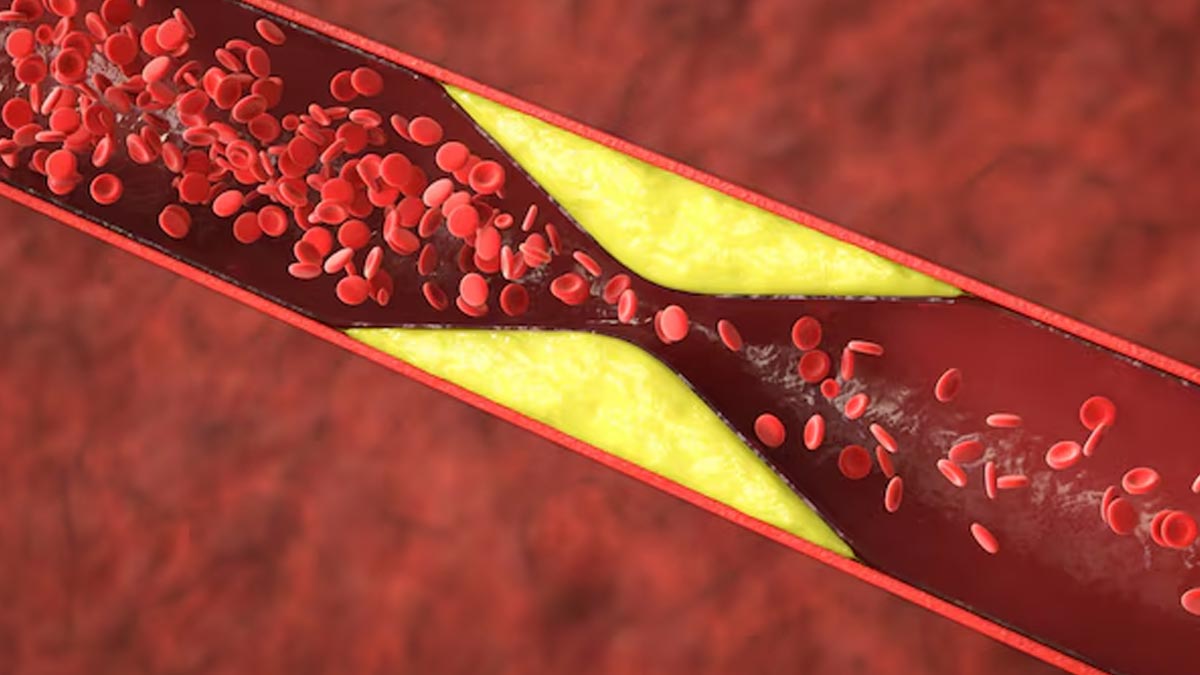 reduce-clogged-arteries-during-winters-in