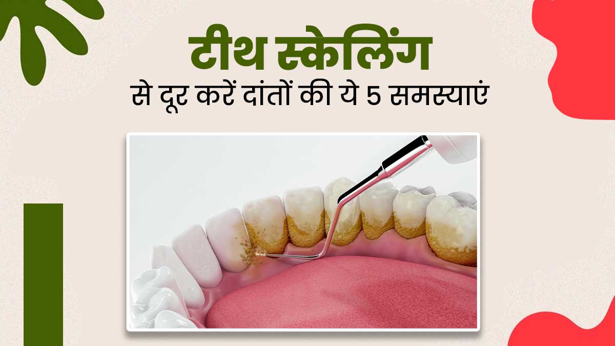 टीथ स्‍केल‍िंग से दूर करें ओरल हेल्‍थ से जुड़ी ये 5 समस्‍याएं, स्‍वस्‍थ रहेंगे दांत