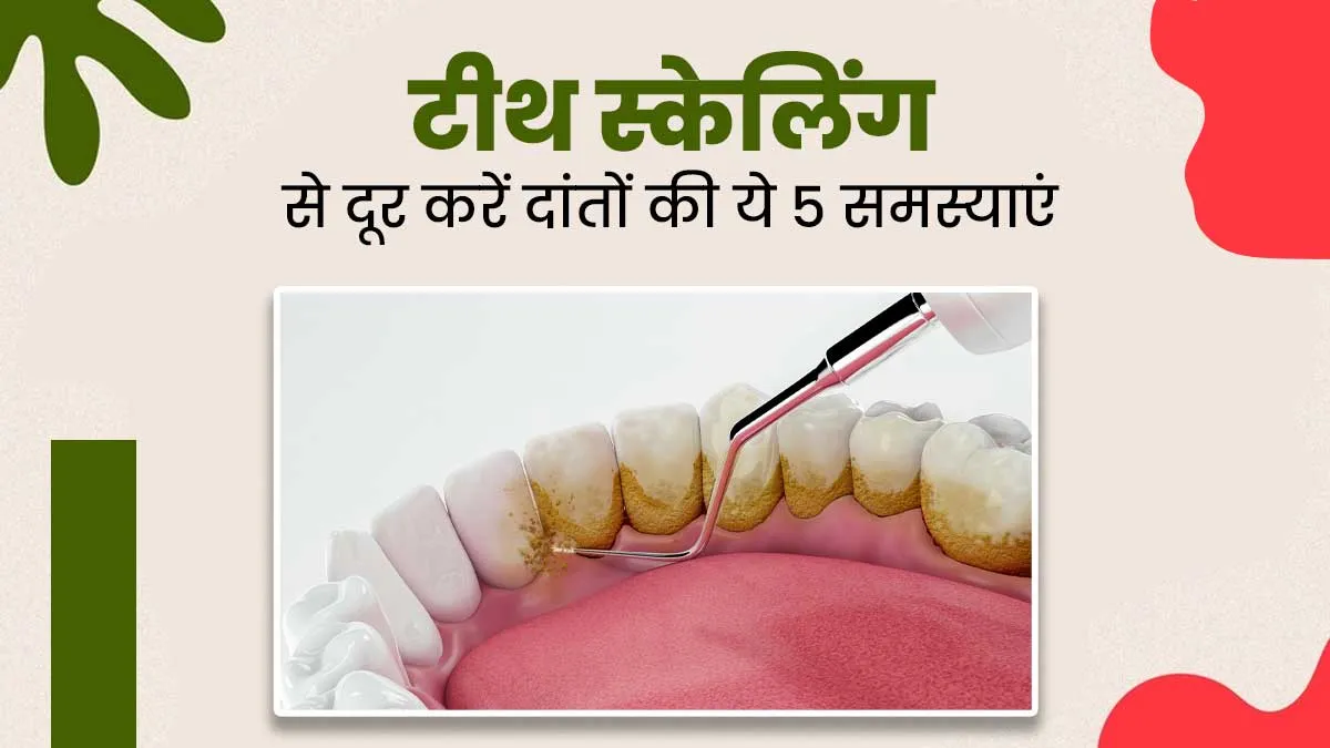 टीथ स्‍केल‍िंग से दूर करें ओरल हेल्‍थ से जुड़ी ये 5 समस्‍याएं, स्‍वस्‍थ रहेंगे दांत