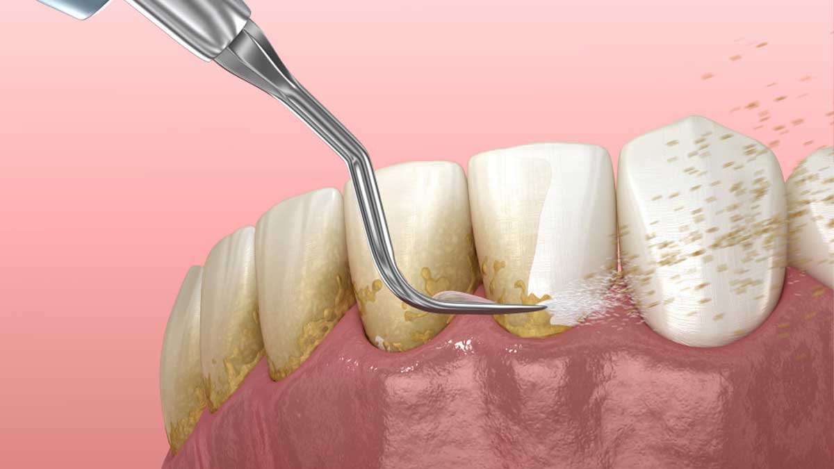 teeth-scaling-benefits