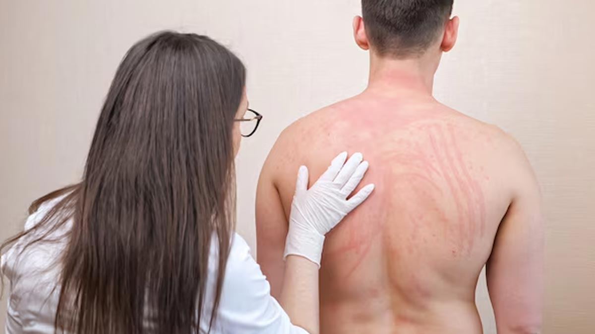 backer-nevus-syndrome-in