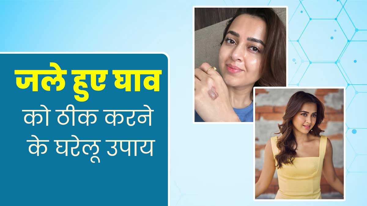 शो में कुकिंग के दौरान एक्ट्रेस तेजस्वी प्रकाश का जला हाथ, जानें जले हुए घाव को ठीक करने के घरेलू उपाय