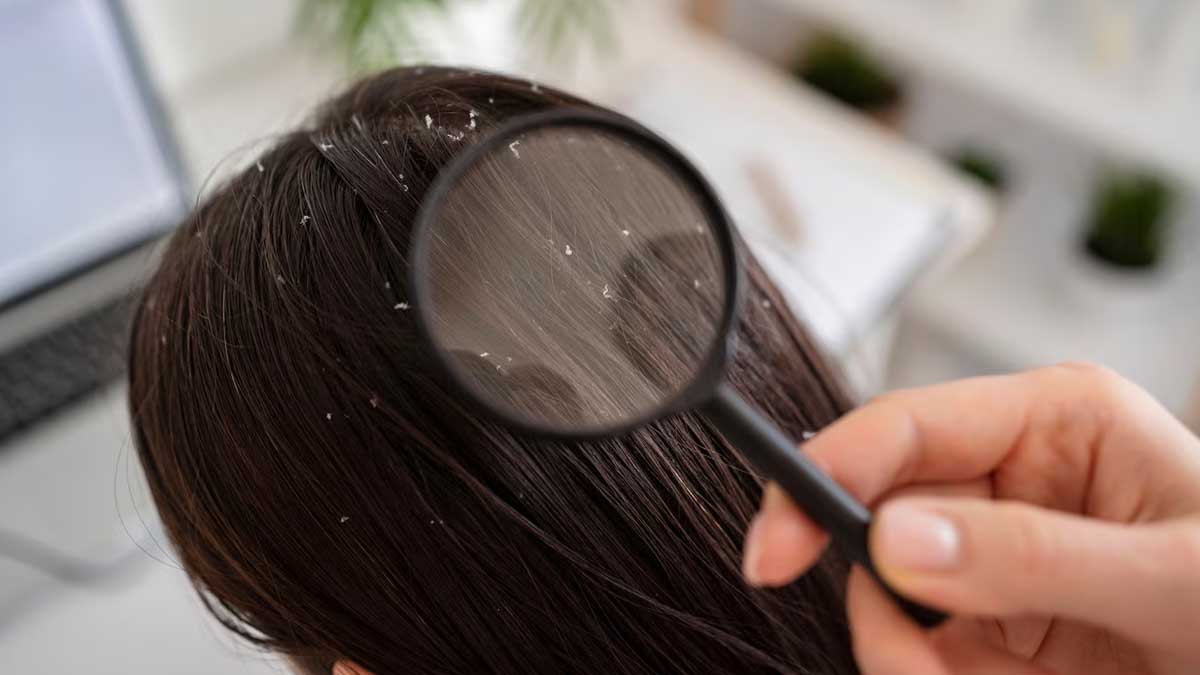 anti dandruff Shampoo