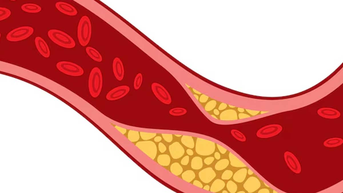 is-hypertriglyceridemia-same-as-high-cholesterol-in