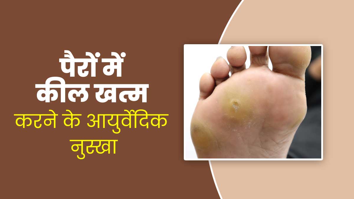 पैरों में कील (Foot Corns) को खत्म करने में मदद करेगा ये आयुर्वेदिक नुस्खा, आज ही करें ट्राई