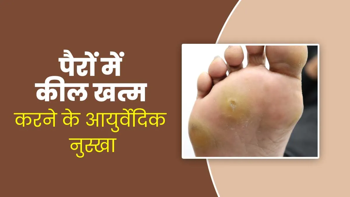 पैरों में कील (Foot Corns) को खत्म करने में मदद करेगा ये आयुर्वेदिक नुस्खा, आज ही करें ट्राई