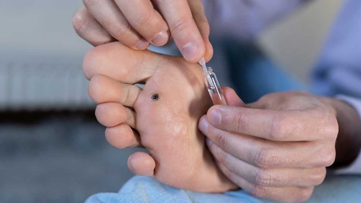 How-to-Relieve-Foot-Corn-inside