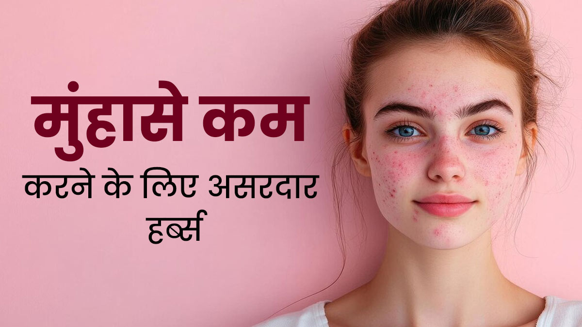 मुंहासे से छुटकारा दिलाने में कारगर हैं ये 5 हर्ब्स, जानें फायदे