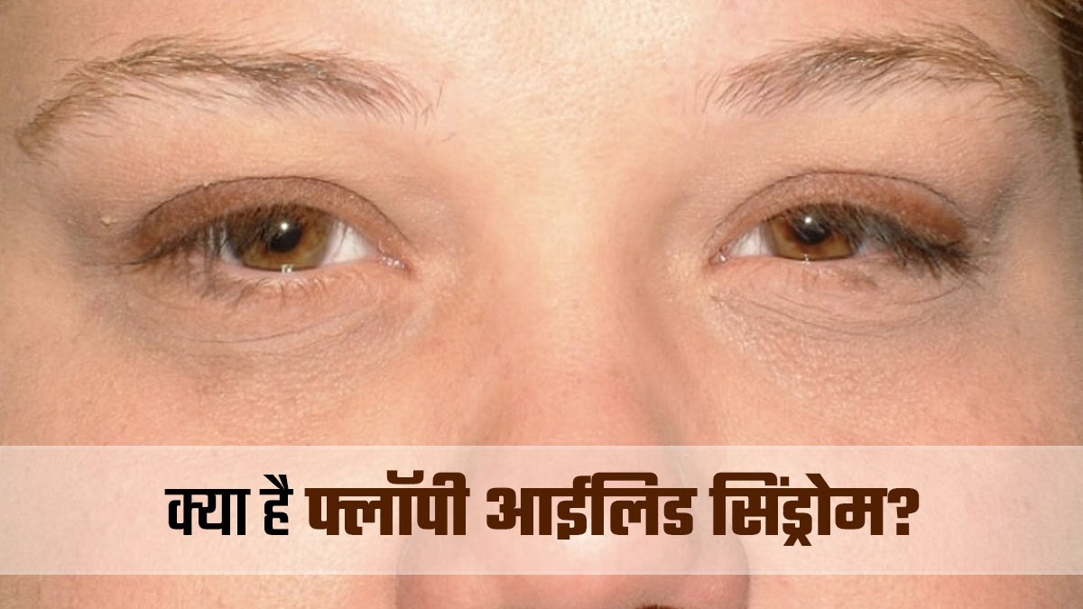 फ्लॉपी आईलिड सिंड्रोम में लटक जाती हैं आंखों की पलकें, डॉक्‍टर से जानें इस बीमारी के लक्षण, कारण और इलाज