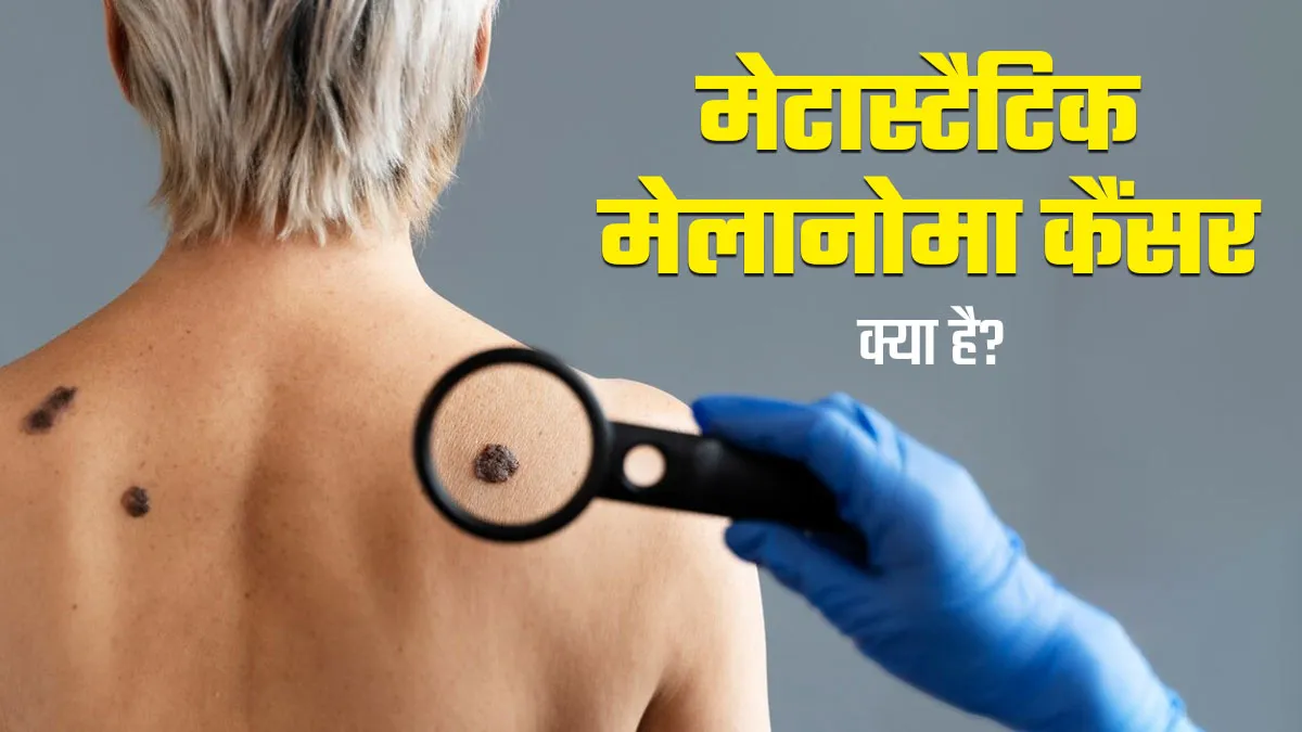 कितना खतरनाक है मेटास्टैटिक मेलानोमा कैंसर, डॉक्टर से जानें इसके लक्षण और बचाव के तरीके