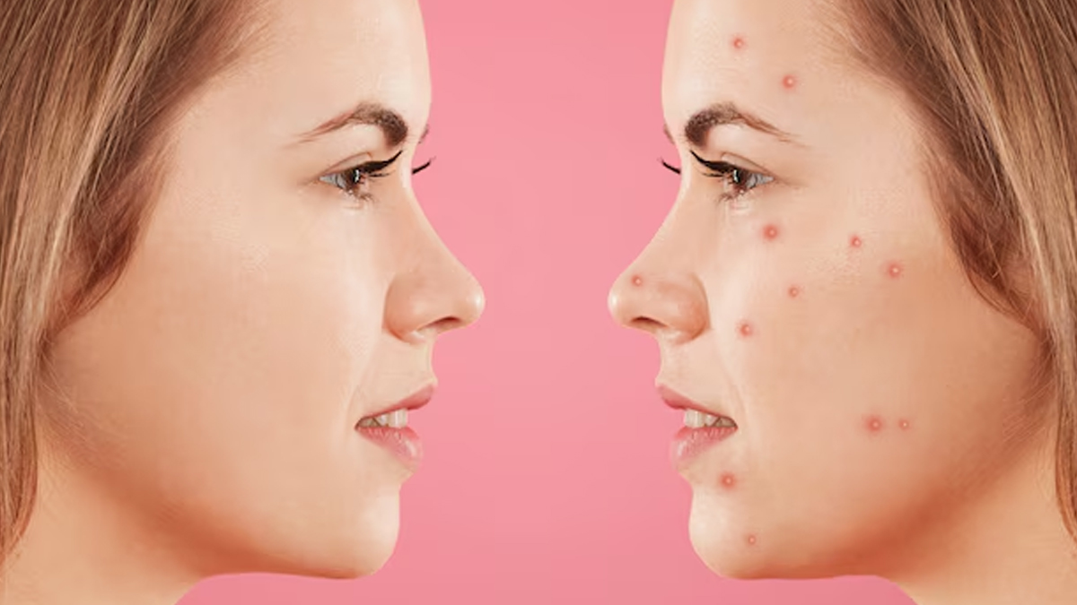 can smoking cause acne 1