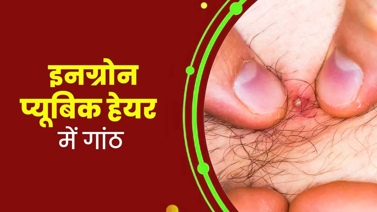 इनग्रोन प्यूबिक हेयर में अंदर गांठ बन जाने के क्या कारण हो सकते हैं? डॉक्‍टर से जानें इससे बचने के उपाय