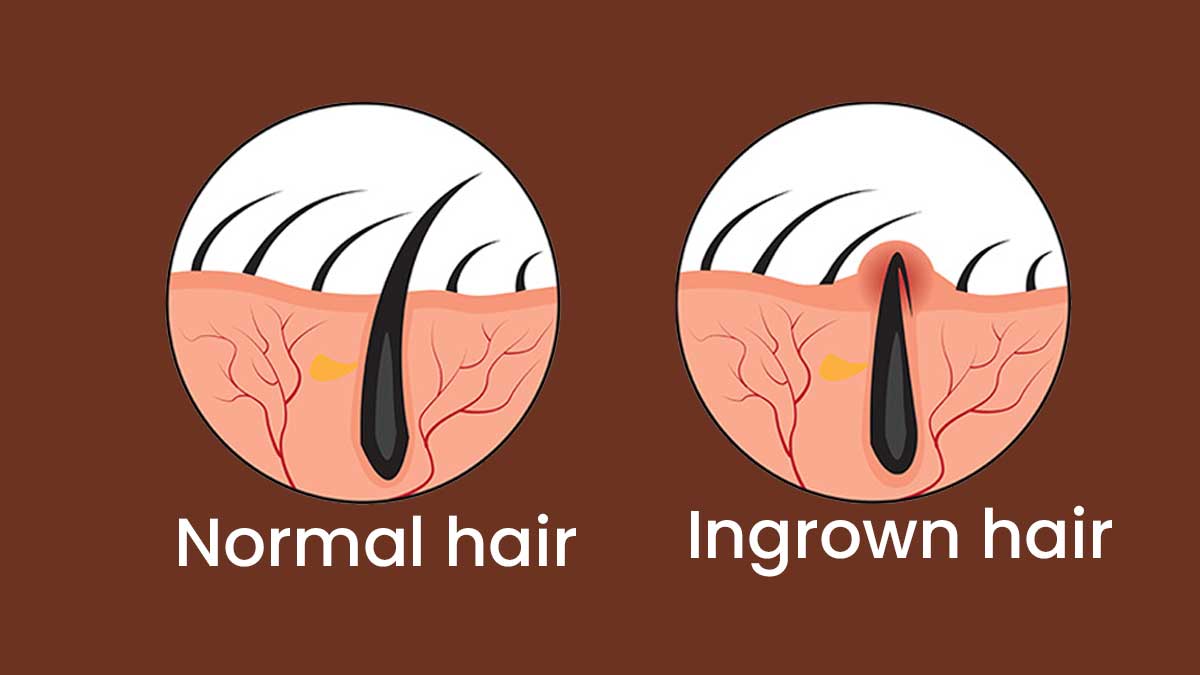 ingrown-pubic-hair-cyst