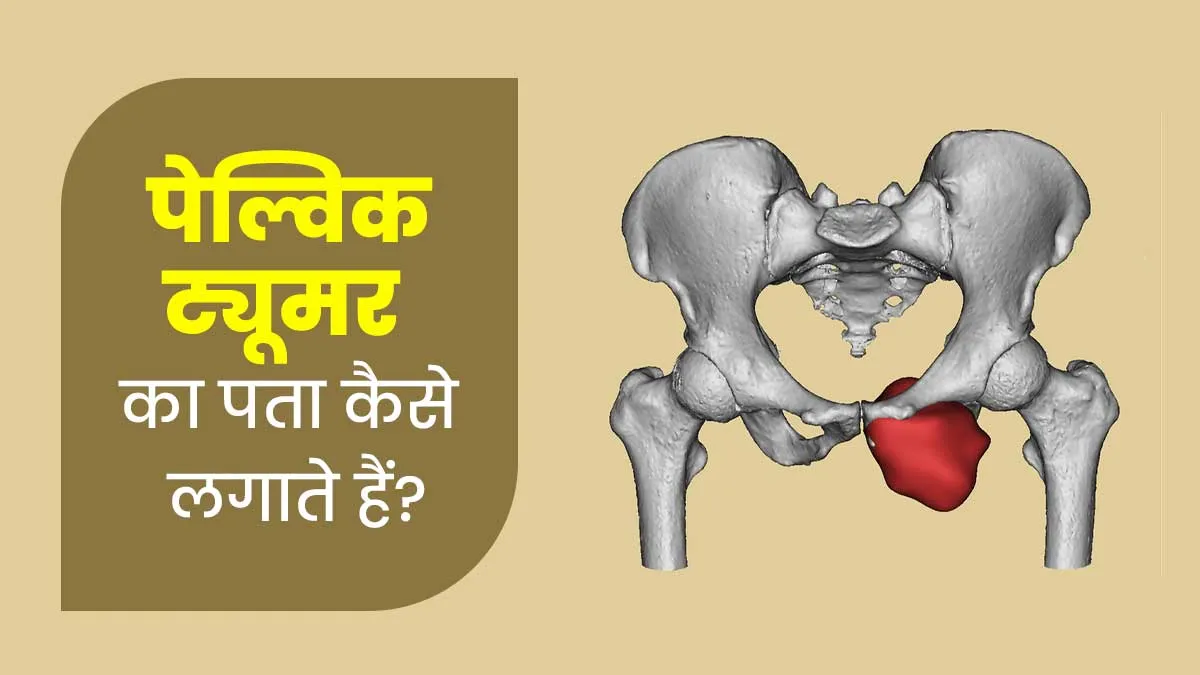 पेल्विक ट्यूमर (पेट के निचले हिस्से में होने वाले ट्यूमर) का पता कैसे लगाया जाता है? डॉक्‍टर से जानें