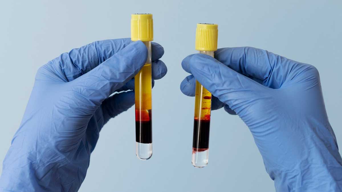 lactic-acidosis-treatment