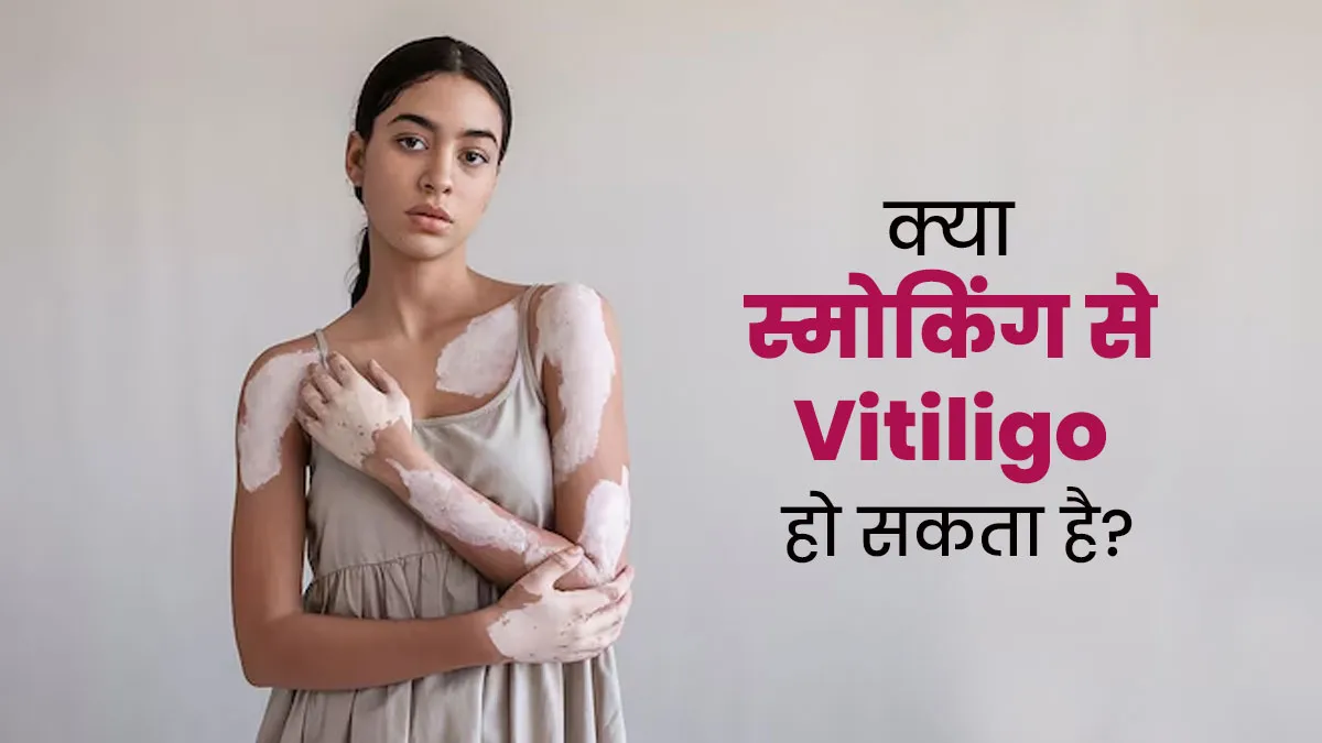 क्या स्मोकिंग से विटिलिगो हो सकता है? बता रहे हैं डॉक्टर