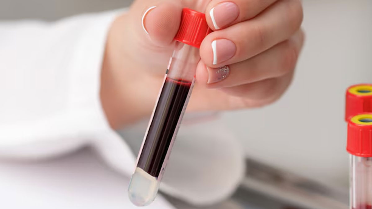 Osmotic-Fragility-Test