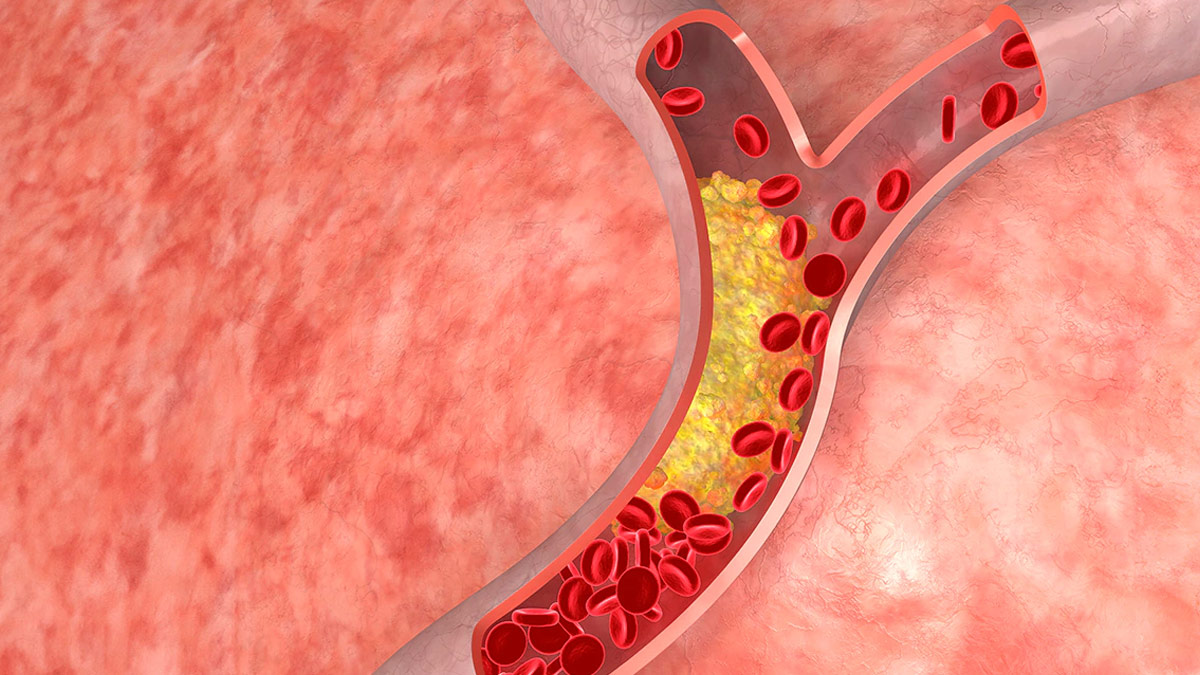 Ayurvedic-churan-Recipe-to-Control-high-Cholesterol-inside