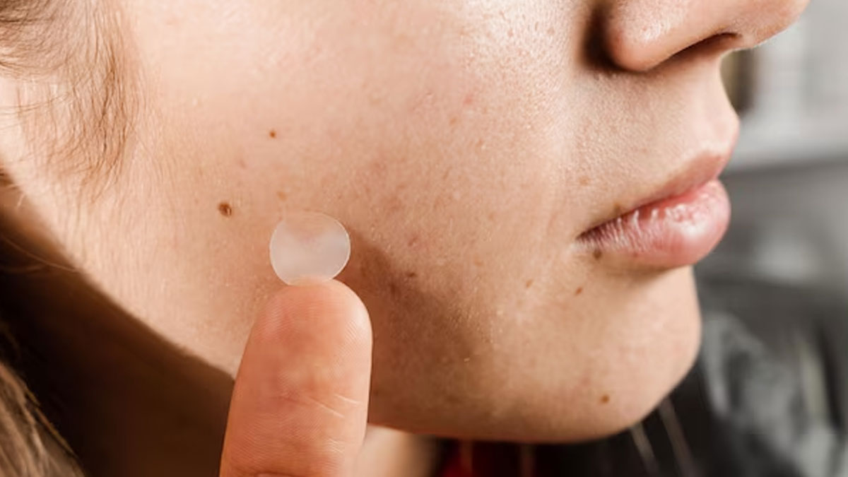 acne patches