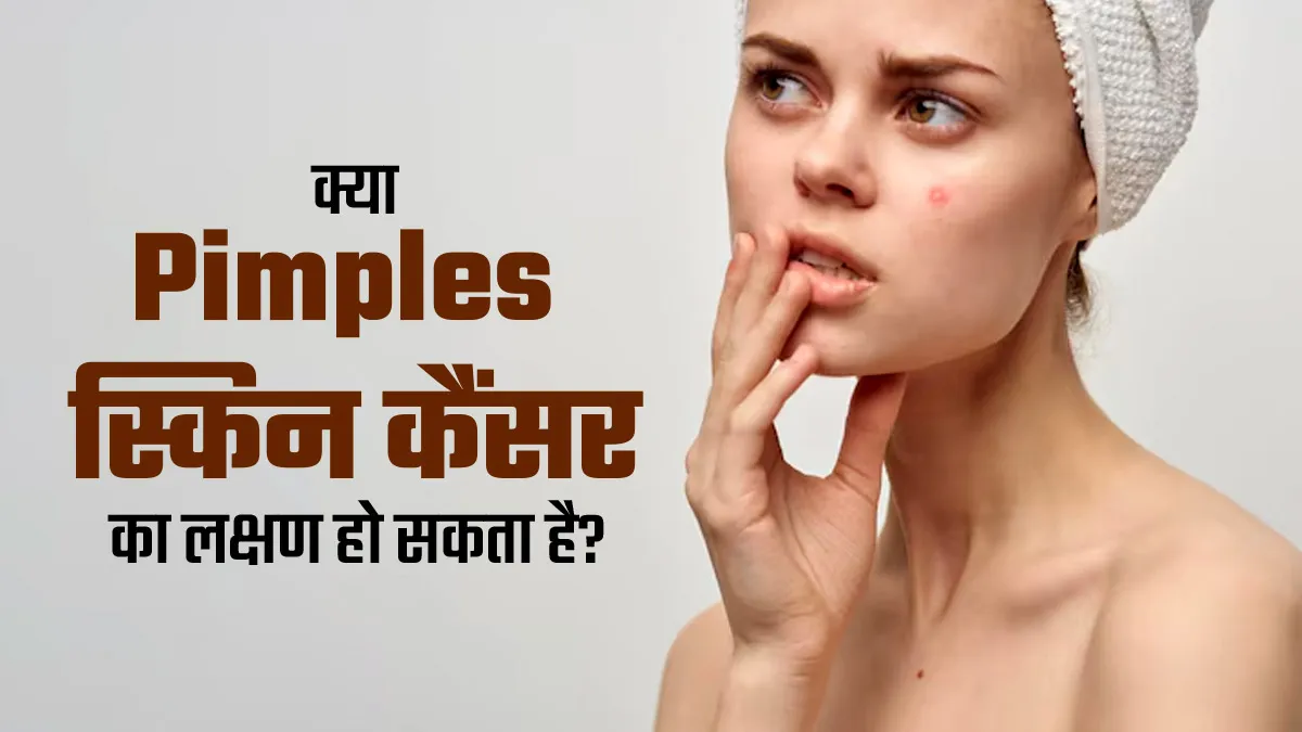 क्या पिंपल्स स्किन कैंसर के शुरुआती लक्षण हो सकते हैं? डॉक्टर से जानें