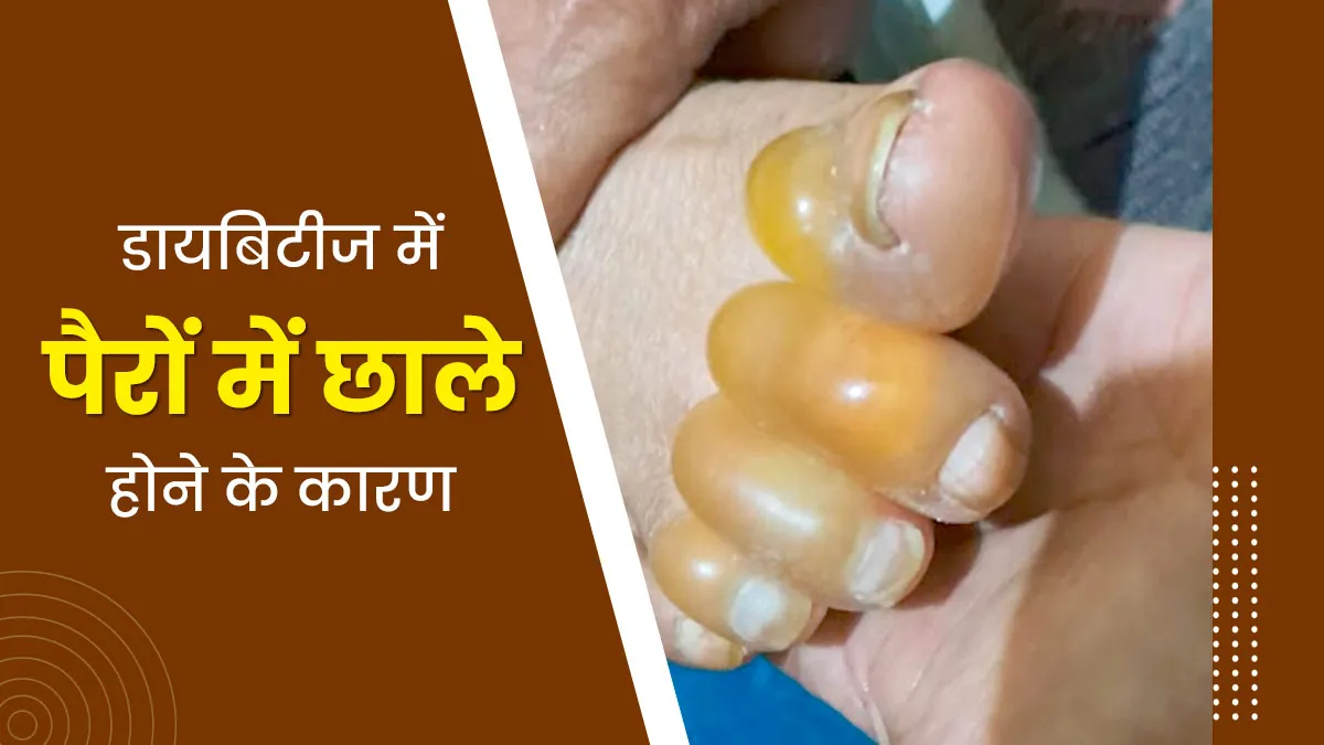 डायबिटीज में पैरों में होने वाले छाले (Diabetic Blisters) क्या हैं और क्यों होते हैं? जानें डॉक्टर से