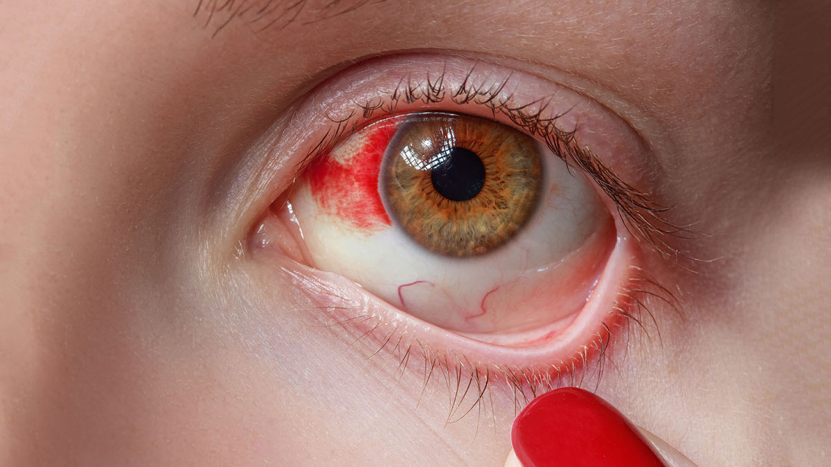 pink eye