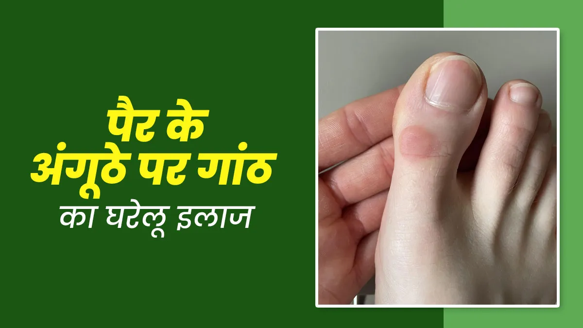 पैर के अंगूठे पर गांठ से होता है दर्द और सूजन, राहत के ल‍िए अपनाएं ये 5 घरेलू उपाय