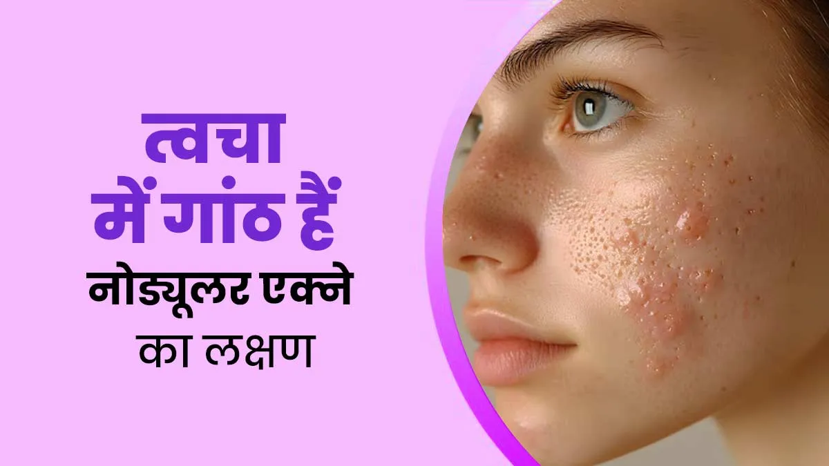 गांठ और दर्द वाले मुंहासे हैं Nodular Acne, डॉक्‍टर से जानें इसके लक्षण, कारण और इलाज