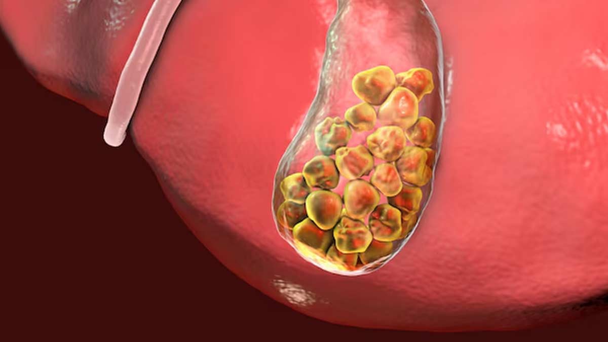liver-infection-and-gallstones