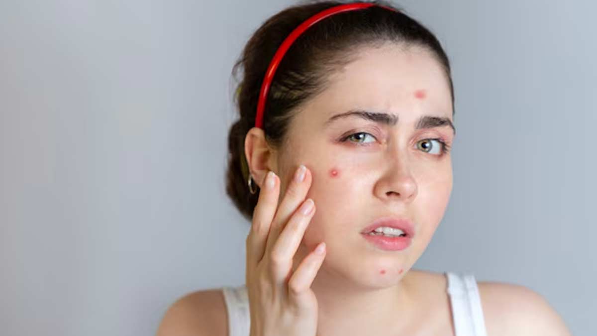 nodular-acne-symptoms