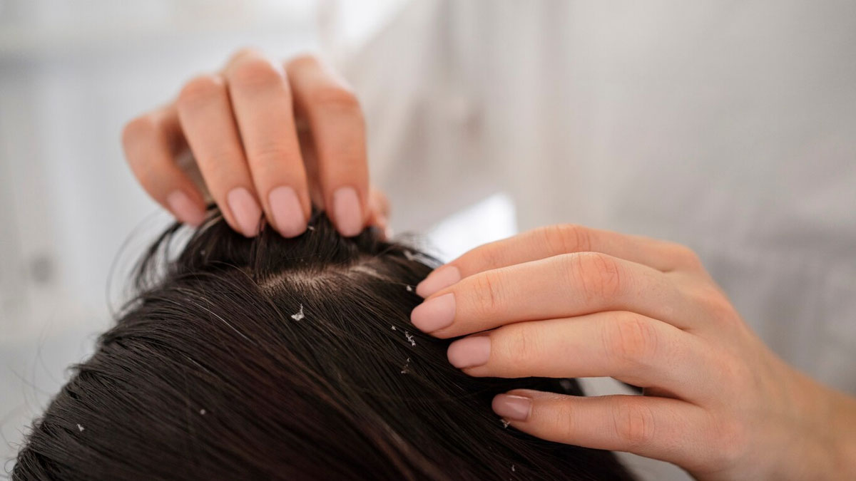 how to get rid of dandruff