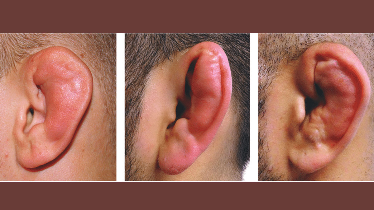 cauliflower-ear-treatment