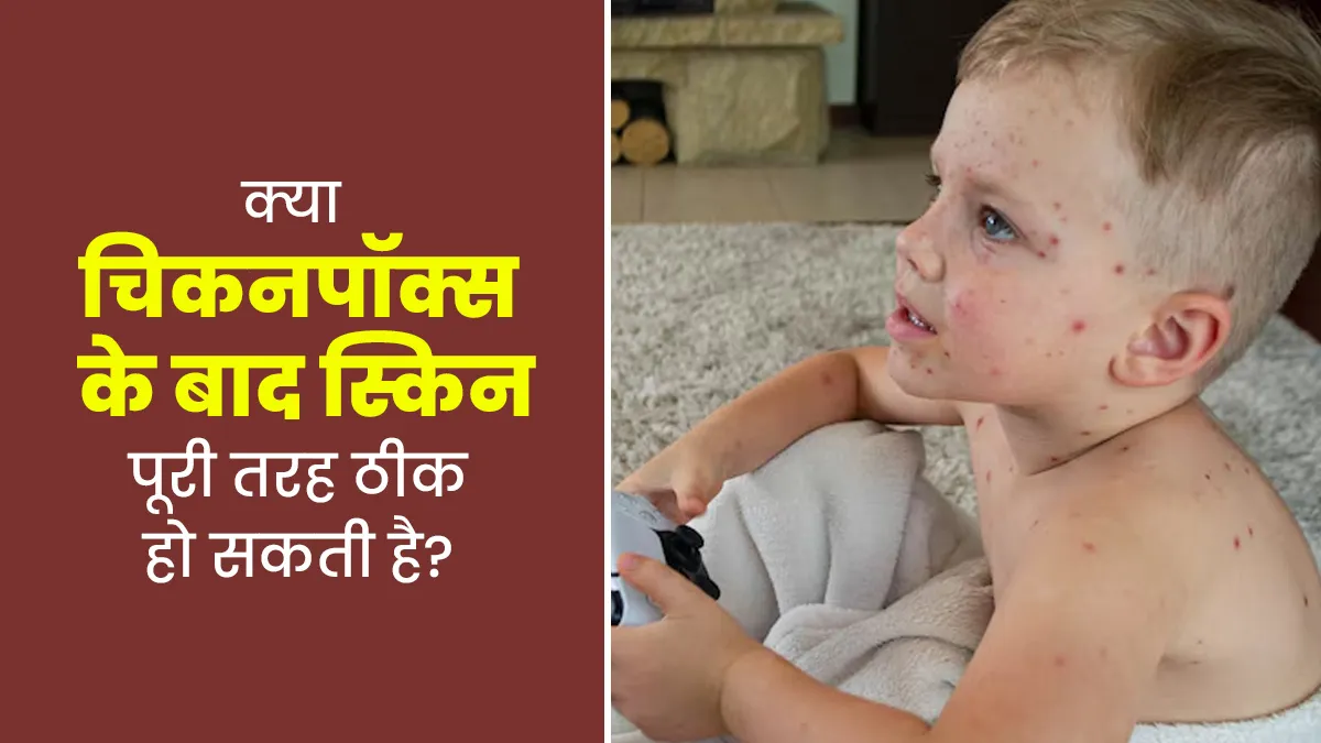 क्या चिकनपॉक्स (छोटी माता) ठीक होने के बाद स्किन के दाग-धब्बे पूरी तरह हटाए जा सकते हैं? डॉक्टर से जानें
