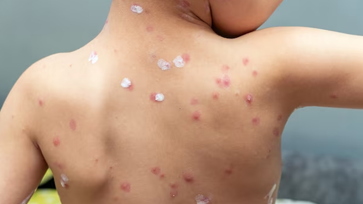 Chickenpox scars treatment