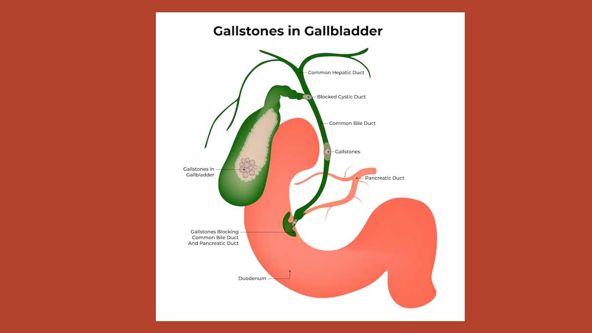 gallstones