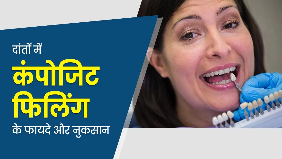 दांतों में दरार भरने के लिए कंपोजिट फिलिंग कराना चाहते हैं, तो जान लें इसके फायदे और नुकसान