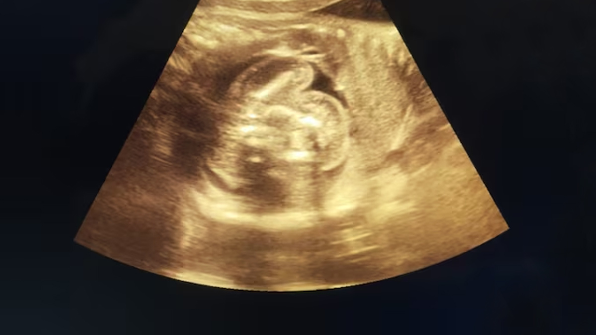 fetus-in-fetu