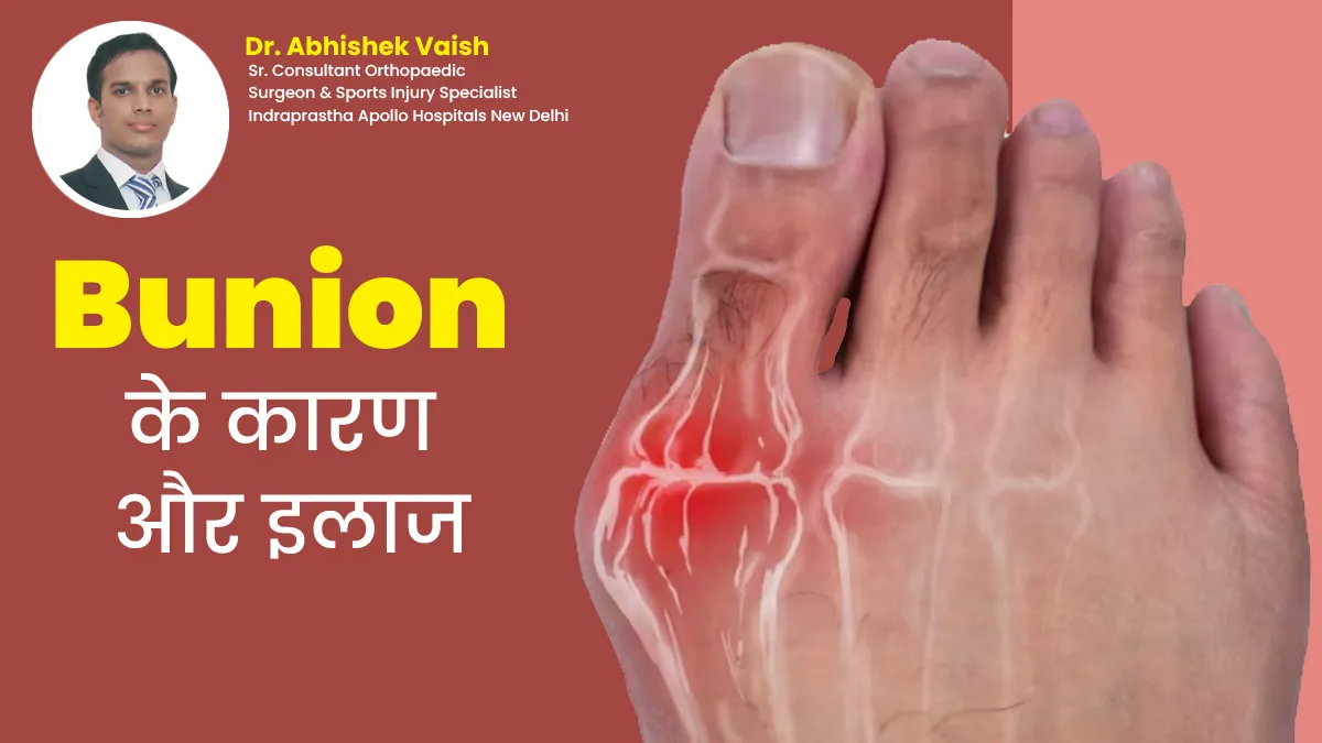 हड्डी बढ़ने से पैर के अंगूठे का टेढ़ा होना है गोखरू (बनियन) की समस्या, डॉक्टर से जानें इसके कारण और इलाज