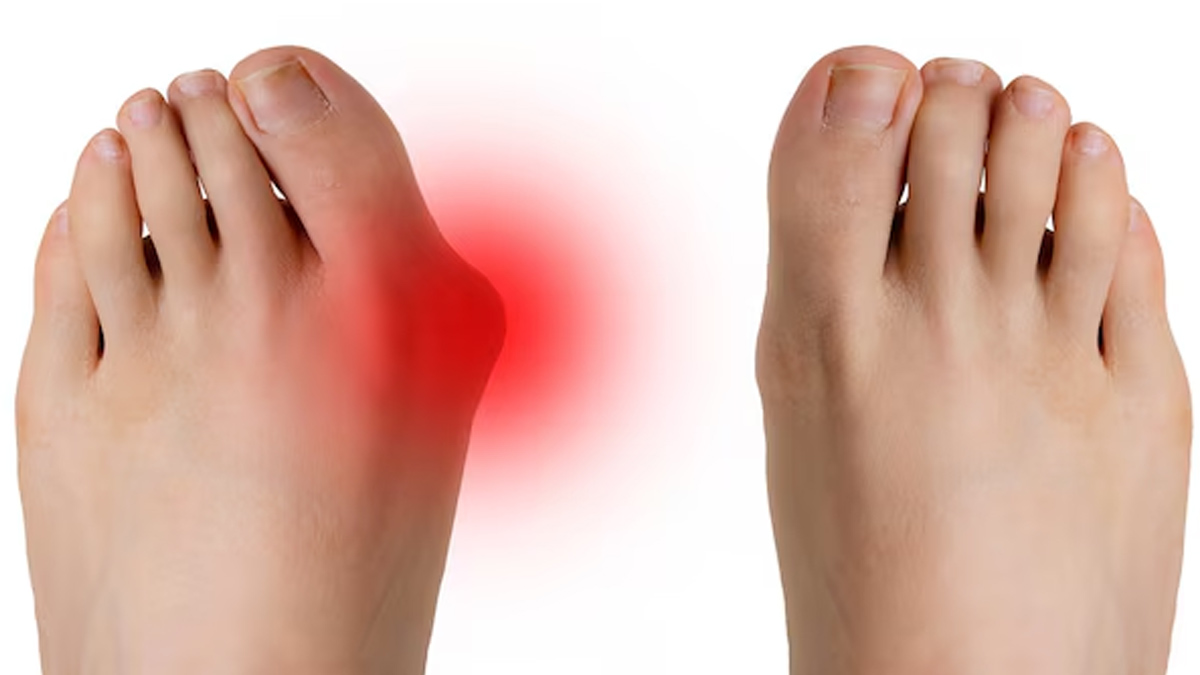 what is bunion  (1)
