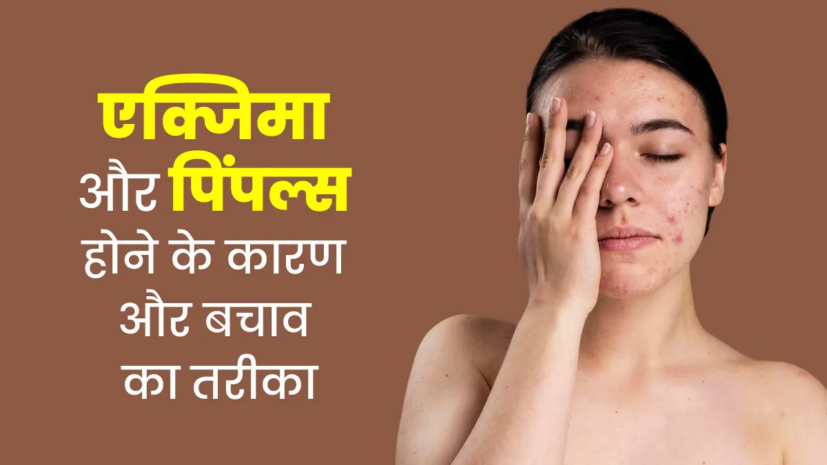 एक्जिमा और पिंपल्स एकसाथ हो गए? डॉक्टर से जानें इसके कारण और बचाव के उपाय