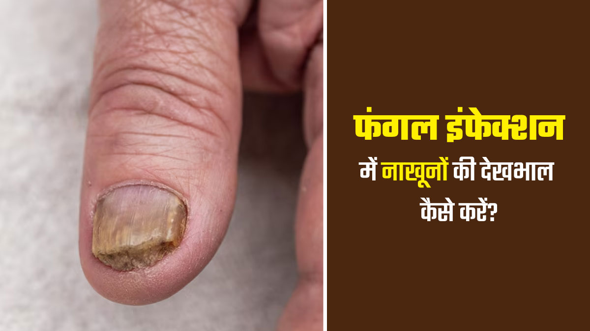 नाखूनों में फंगल इंफेक्‍शन होने पर कैसे करें इनकी देखभाल? जानें क्‍या करें और क्‍या नहीं