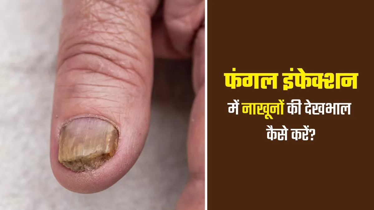 नाखूनों में फंगल इंफेक्‍शन होने पर कैसे करें इनकी देखभाल? जानें क्‍या करें और क्‍या नहीं