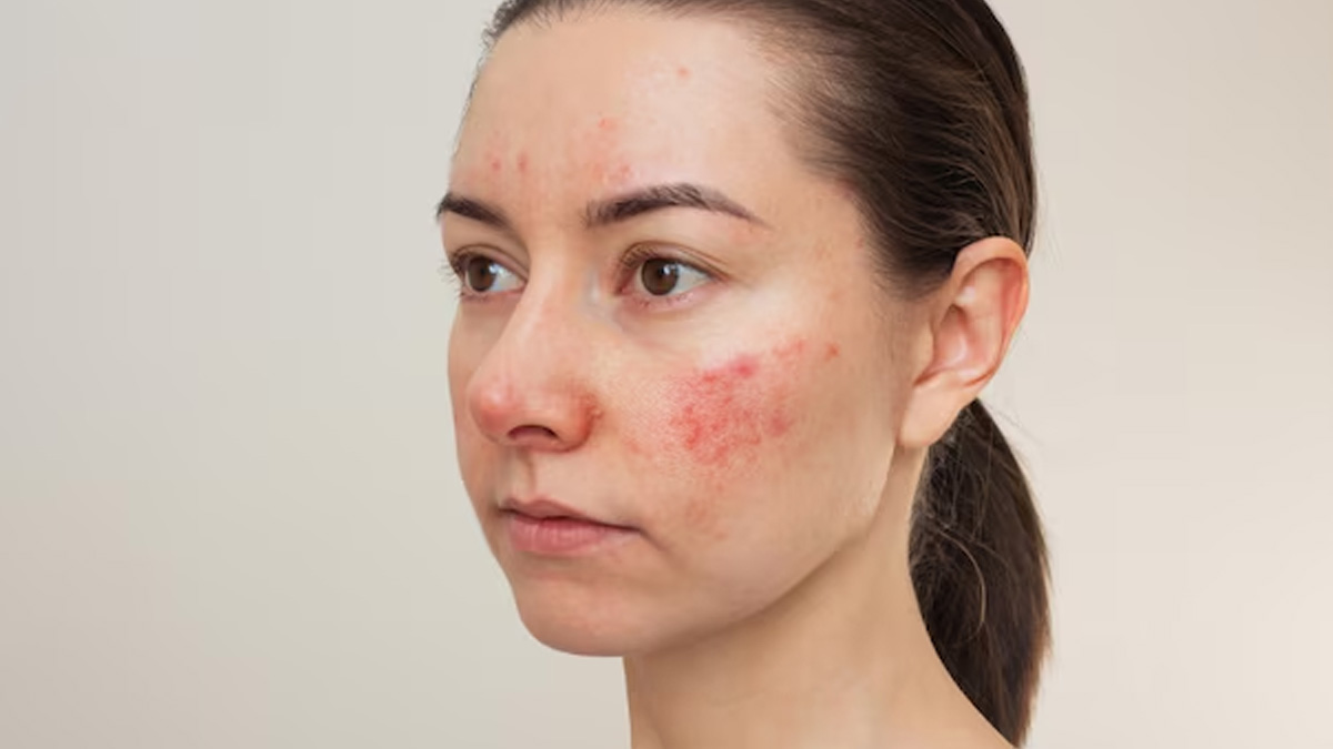Causes Of Eczema And Pimples In Hindi causes-of-eczema-with-pimples-in