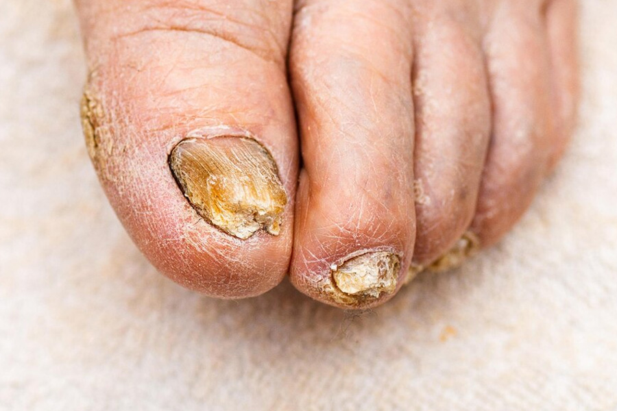 nail-fungal-infection