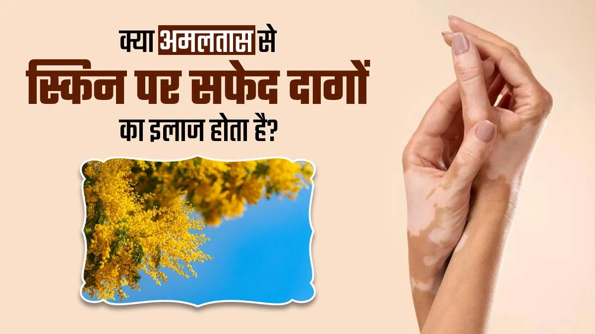 Fact Check: क्या सच में अमलतास से सफेद दाग की समस्या दूर होती है? जानें आयुर्वेदाचार्य से
