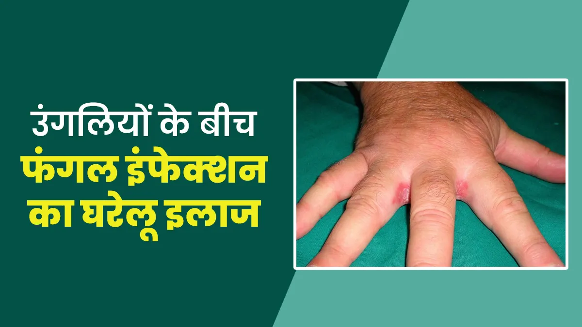 हाथ की उंगलियों के बीच हो जाए फंगल इंफेक्‍शन, तो राहत के ल‍िए अपनाएं ये 5 घरेलू उपाय