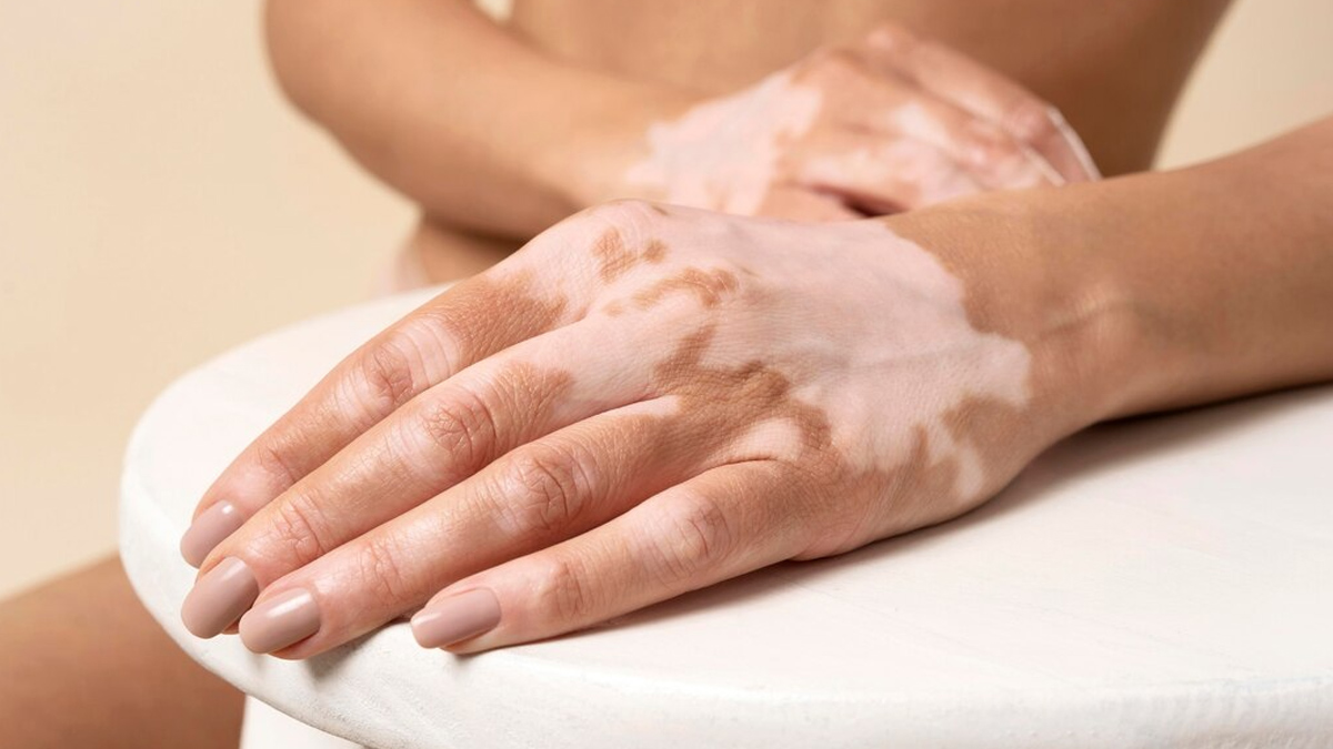 Amaltas For White Spot